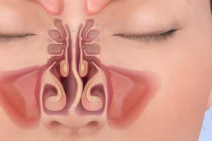 cares-after-septoplasty