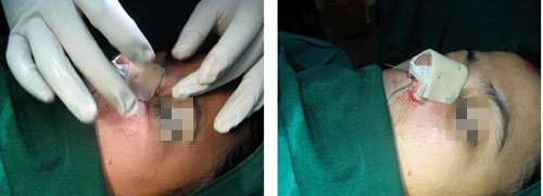 گذاشتن اسپلین روی بینی در مرحله آخر جراحی زیبایی بینی