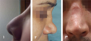 revision rhinoplasty