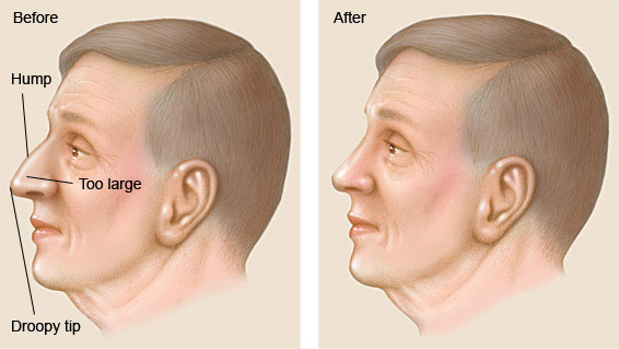 Rhinoplasty in men