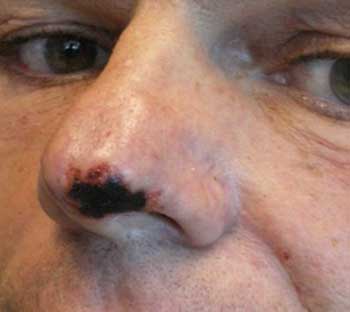 عوارض تزریق ژل به بینی