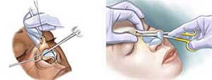 الفرق بين وصول الجراح في عملية تجميل الأنف المفتوحة والمغلقة