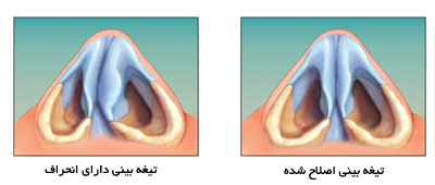 سپتوپلاستی