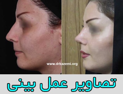 تصاویر قبل و بعد از عمل بینی